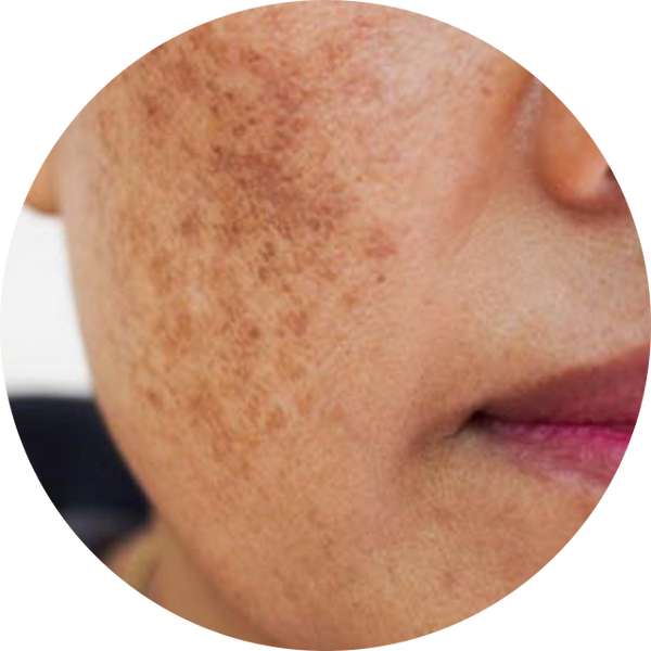 Pigmentation & Dark spots