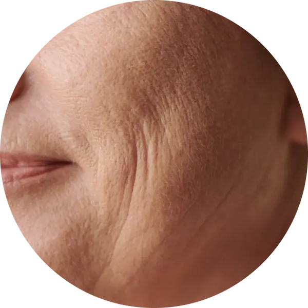 Fine lines & Aging