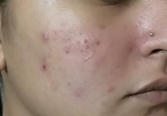 Before After Image
